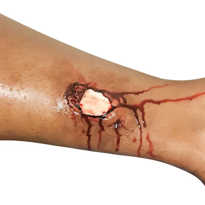 FX TRANSFERS BONE FRACTURE