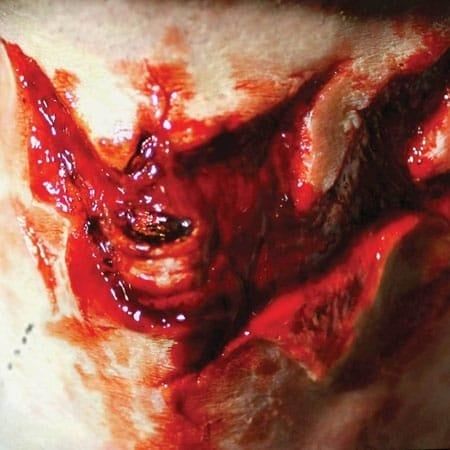 FX TRANSFERS SORE THROAT