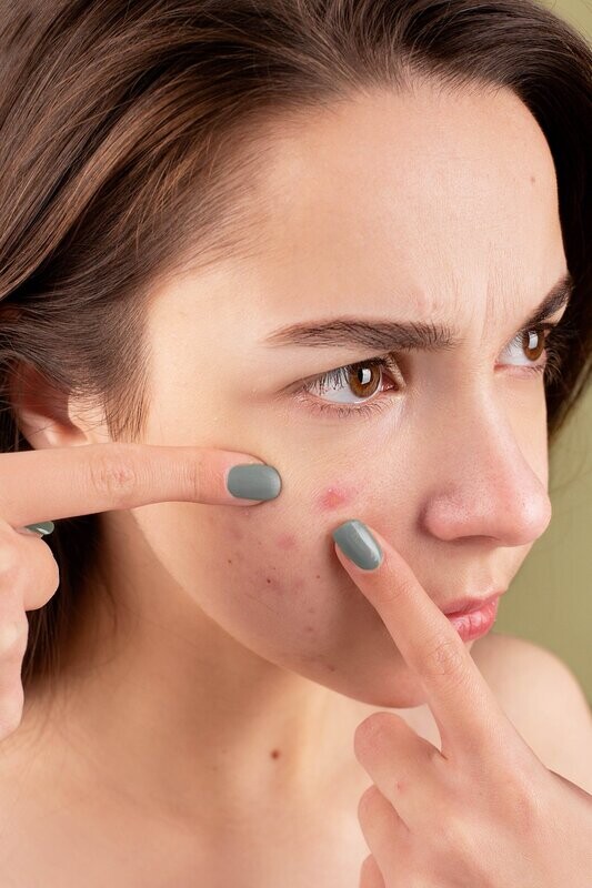 Limpieza facial Antiacné.  Tratamiento profundo. Piel fresca y Limpia