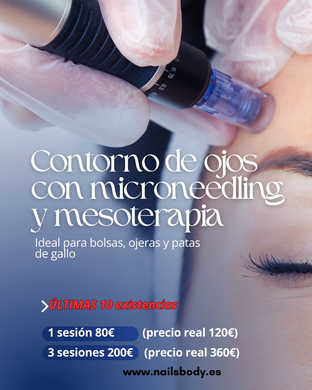 TRATAMIENTO CONTORNO OJOS CON MICRONEEDLING Y MESOTERAPIA