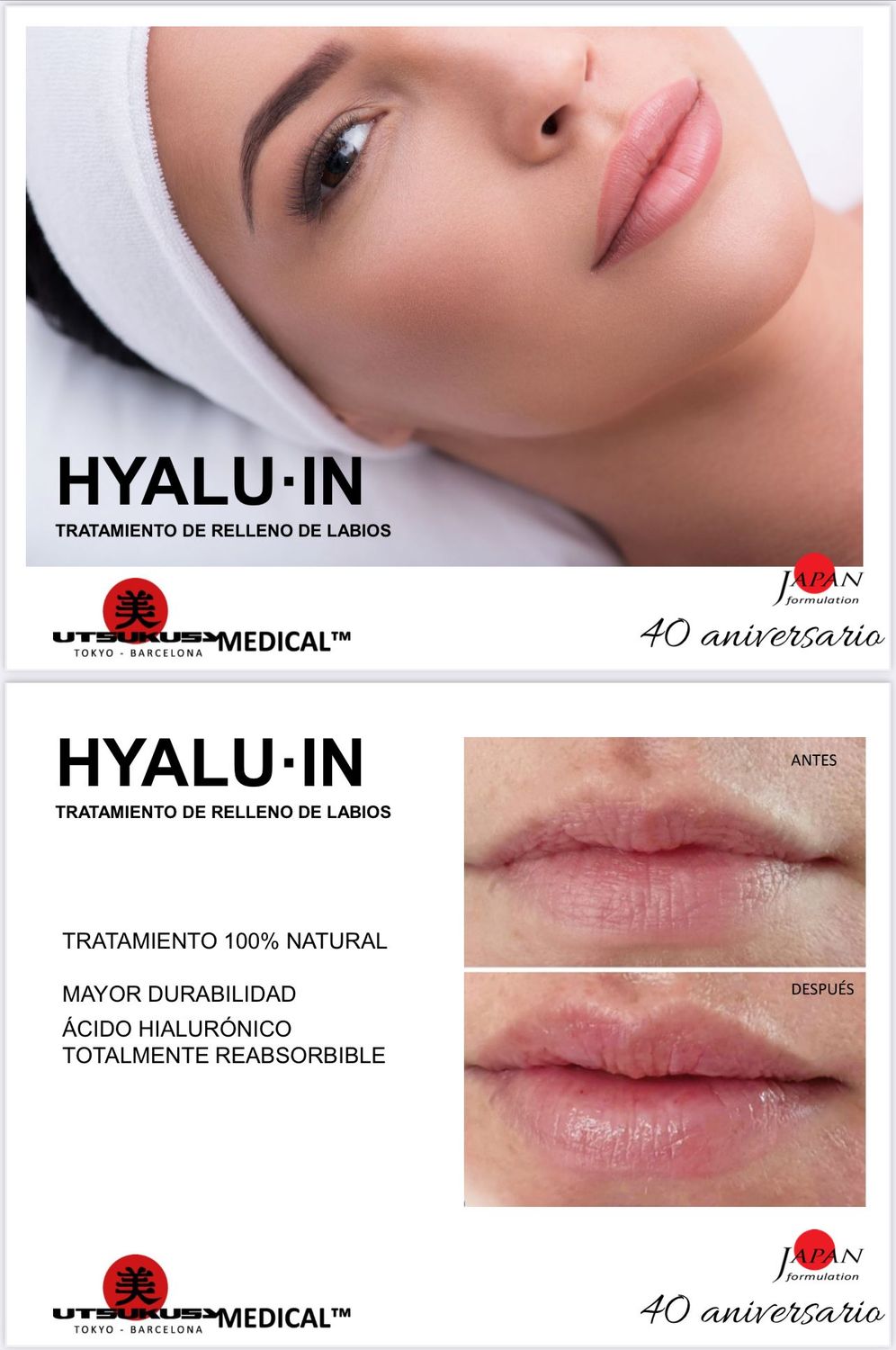 Relleno de labios con microneedling 3 sesiones