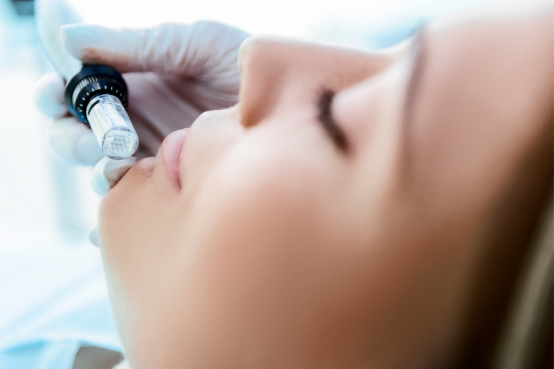 3 SESIONES Microneedling con Factor de crecimiento epidérmico MINIBONOS