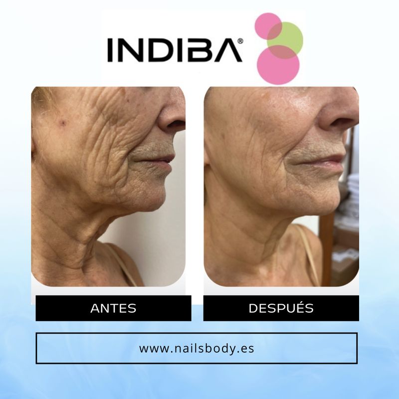 10 sesiones Indiba Día de la Madre