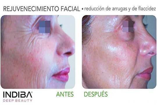 Indiba facial + tratamiento vitamínico