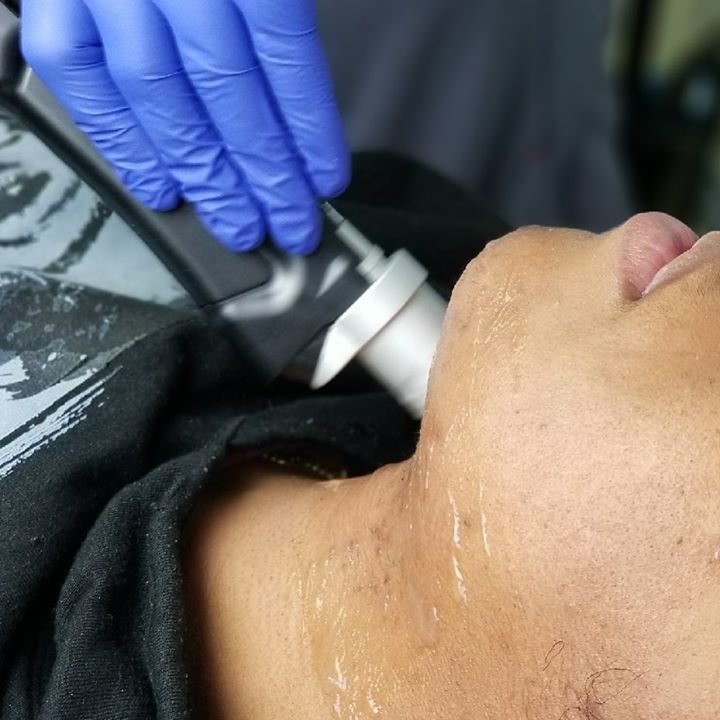 Full Face Laser Hair Removal 3 Sessions Full Face Laser Hair Removal 3 Sessions