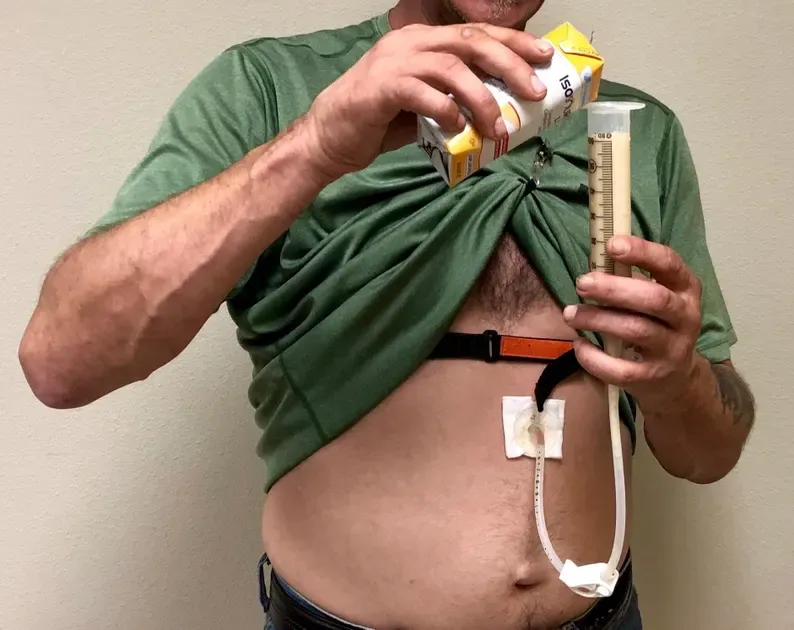Maritz Feeding Tube Set