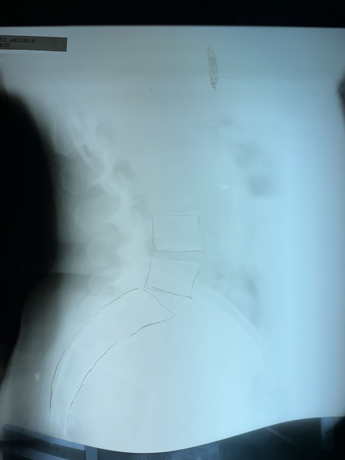 xray full spine