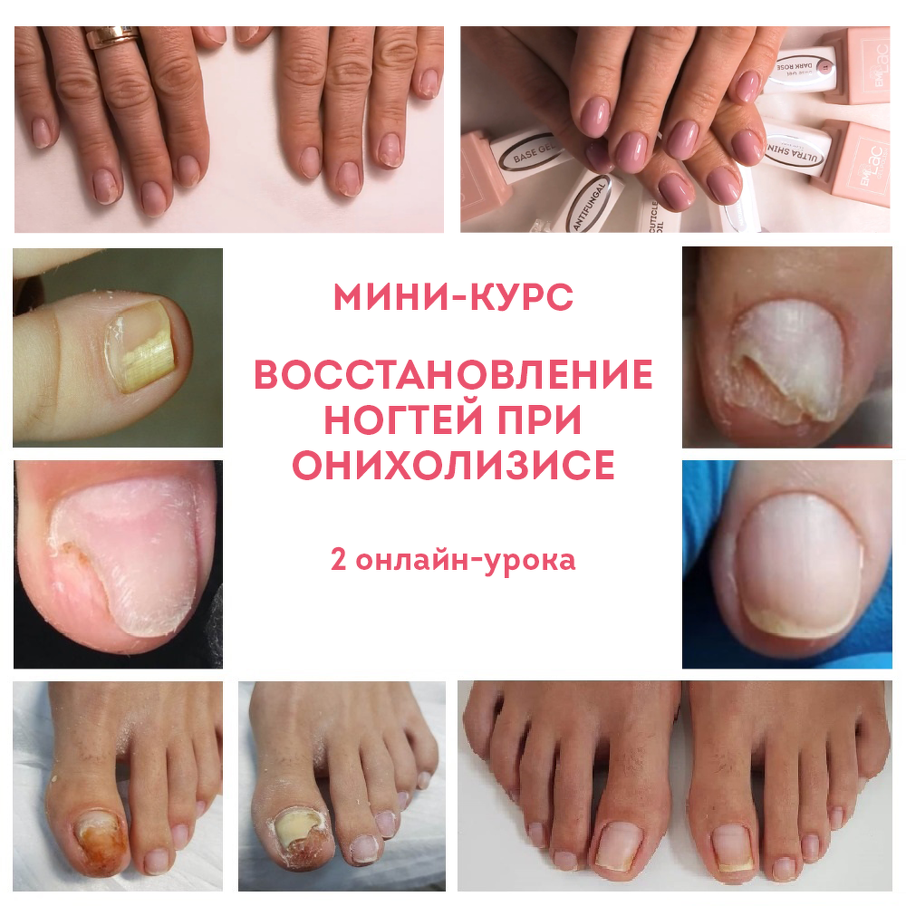 Online Course - Восстановление ногтей при дистрофиях