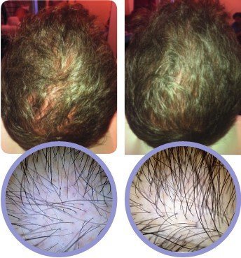 PRP Platelet Rich Plasma Hair Regrowth Therapy