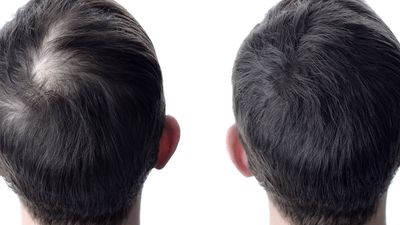 PRP Hair Restoration