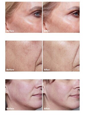 AnteAGE Home Microneedling Solution Intro Kit