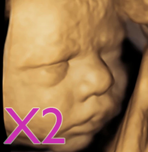 Ecografía Emocional 4D x2 Ecografía Emocional 4D x2