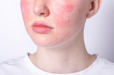 Sensitive Skin &amp; Redness