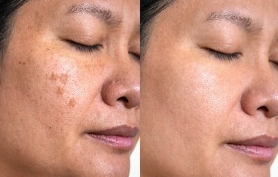 Uneven Tone &amp; Dark Spots