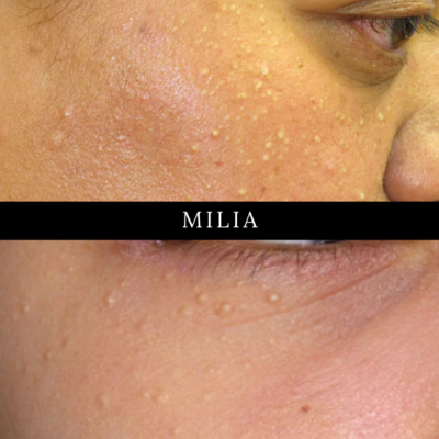 Skin Classic treatment for Acne, Milia and Blackheads