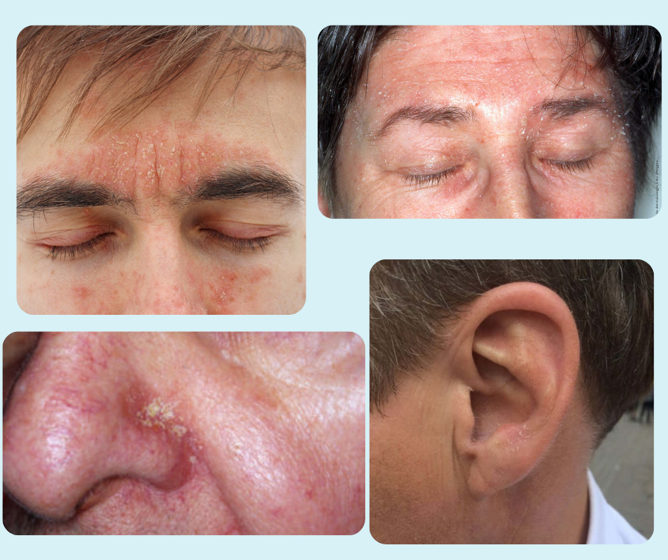 Seborrheic Dermatitis Symptoms Relief Facial