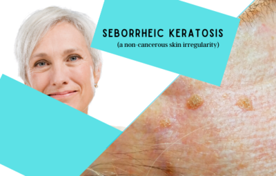 Skin Classic for Seborrheic Keratosis