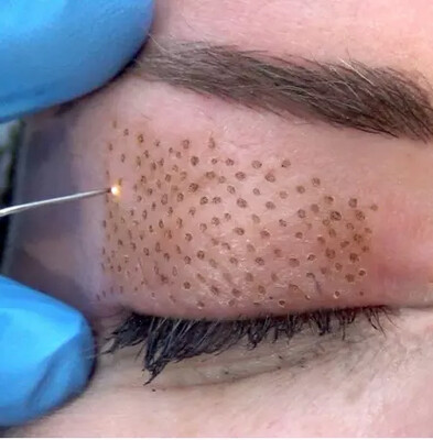 Soin par Plasma Lift -
Blépharoplastie ( réhaussement des paupières ) , rides, ridules, sillons, tâches, vergetures, lifting visage et corps....
A la séance Soin par Plasma Lift -
Blépharoplastie ( réhaussement des paupières ) , rides, ridules, sillons, tâches, vergetures, lifting visage et corps....
A la séance