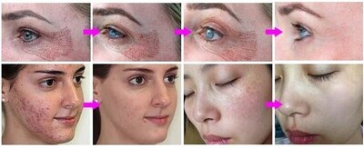 Soin par Plasma Lift - 
Blépharoplastie ( réhaussement des paupières ) , rides, ridules, sillons, tâches, vergetures, lifting visage et corps....
A la séance