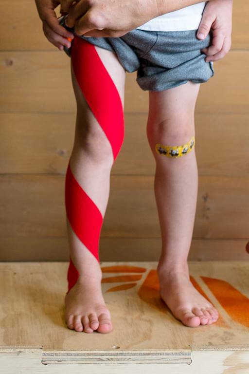 Тейпирование примвальгусной деформации стопы. Косолапость тейпирование. Тейпирование при вальгусе у детей. Тейпирование варусной деформации. Тейпируем косолапость.