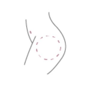 Lipolyse