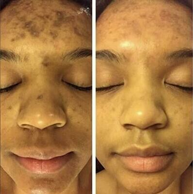የማድያት ክሬም melasma serum cream