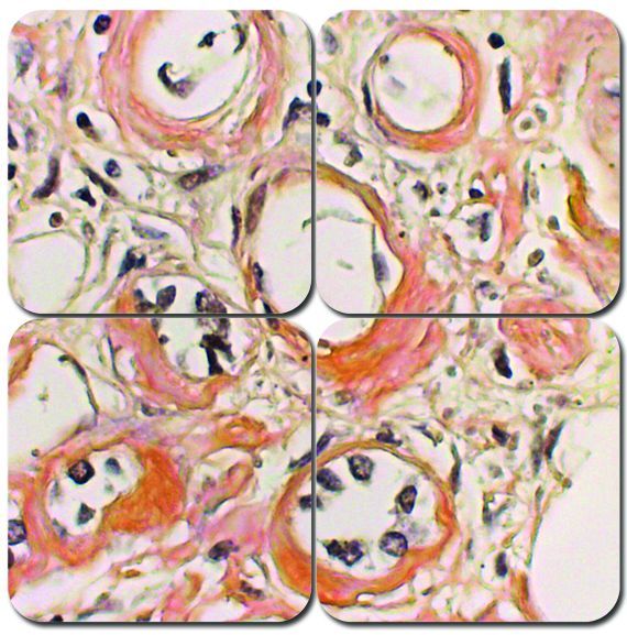 Congo Red Amyloid Stain Kit