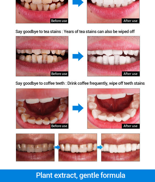 Lanbena teeth whitening essence