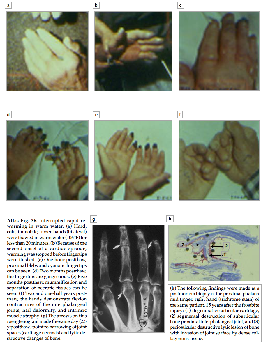 #1 Pictorial Atlas of Freezing Cold Injuries BOOK# 2 –– Download $2.00