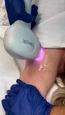 Laser Hair Removal 8 Treatment Packages 20% OFF