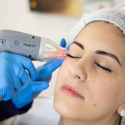 RadioFrequency Collagen Induction Therapy (RF Microneedling)