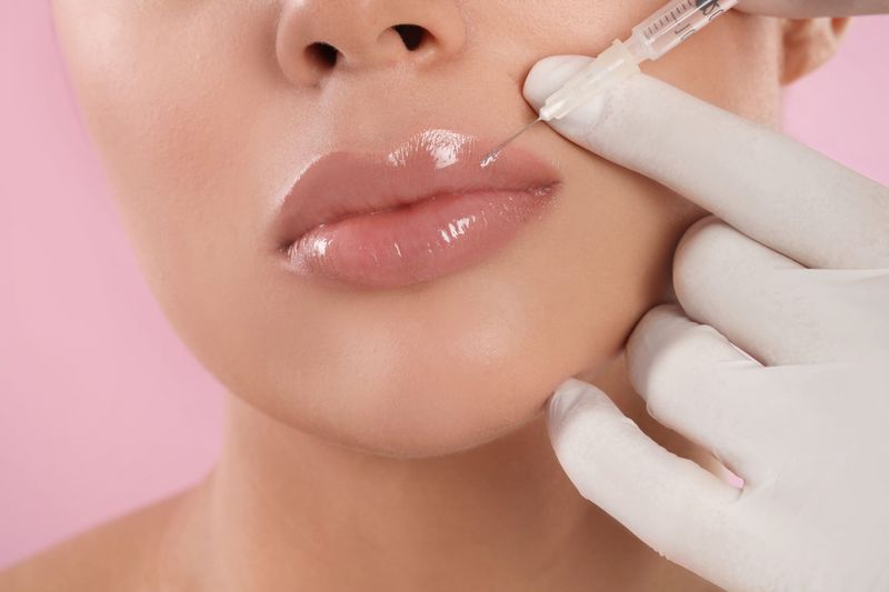 $100 OFF- Lip Filler- 1ml