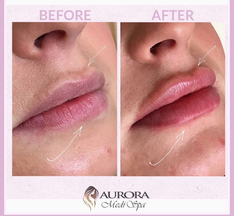 Lip Filler - 1 ML