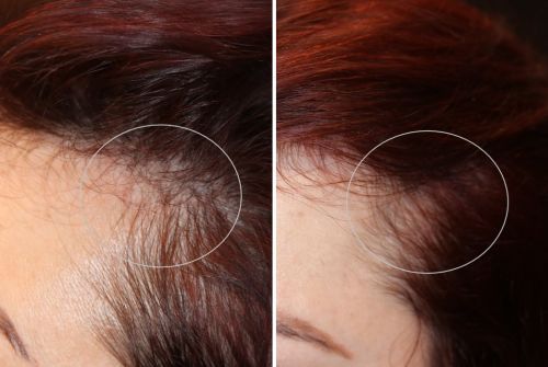 PRP Injections for Hair Restoration