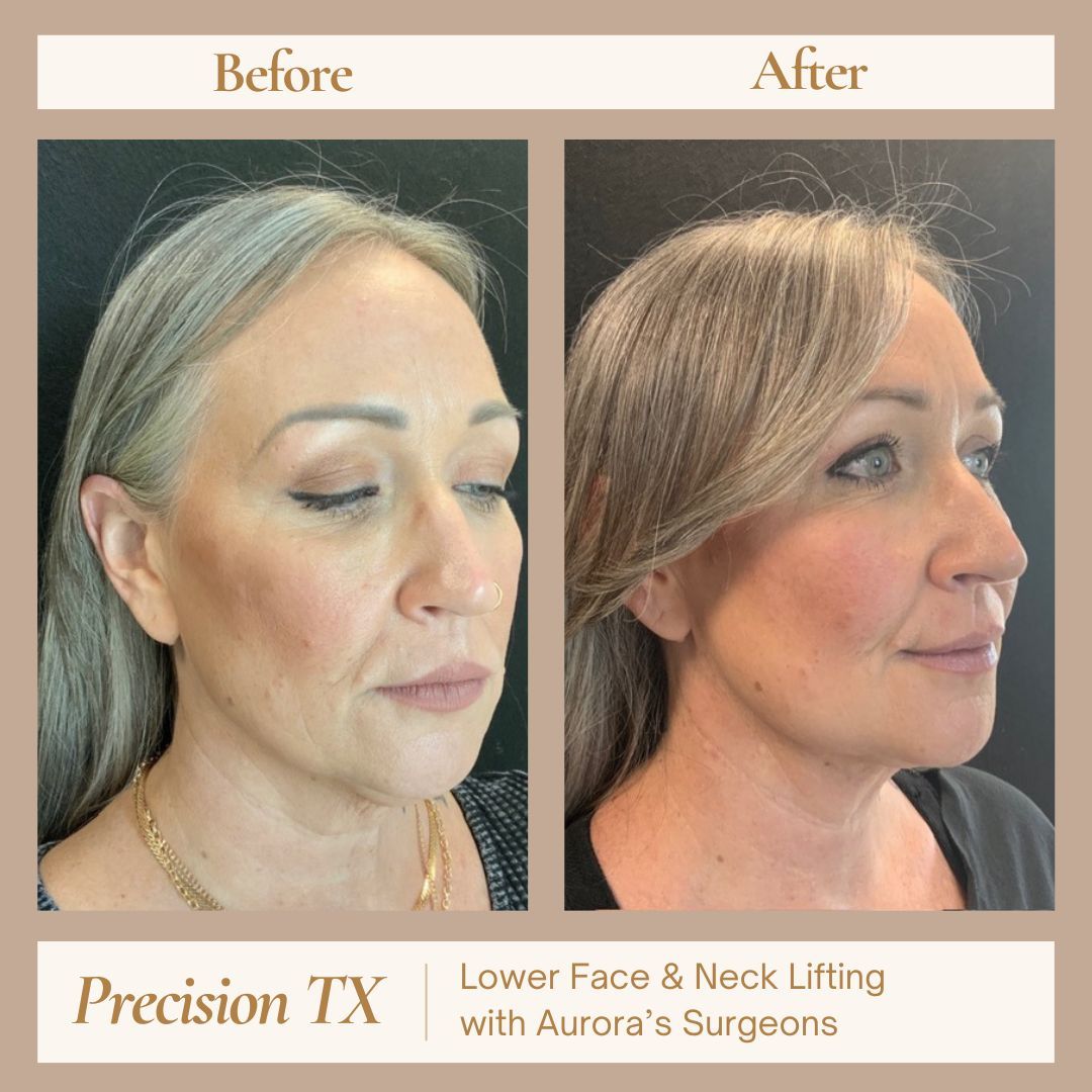 Precision TX- with Aurora's Plastic Surgeon