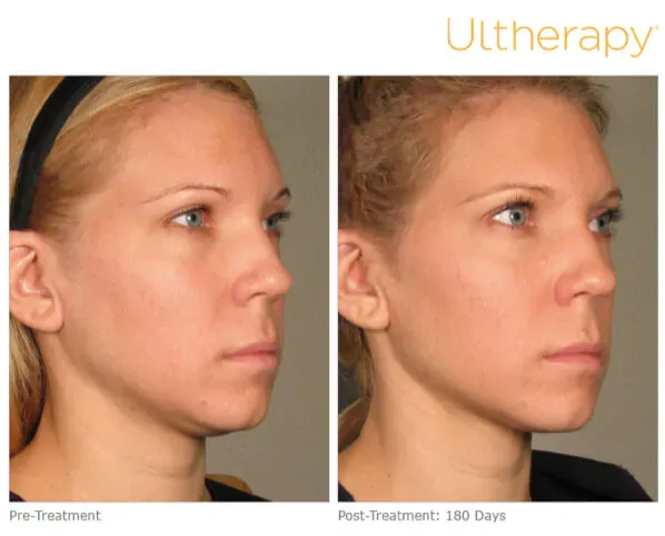 Ultherapy Lower Face Lift