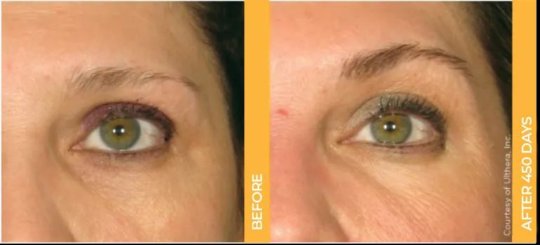 Ultherapy Brow Lift