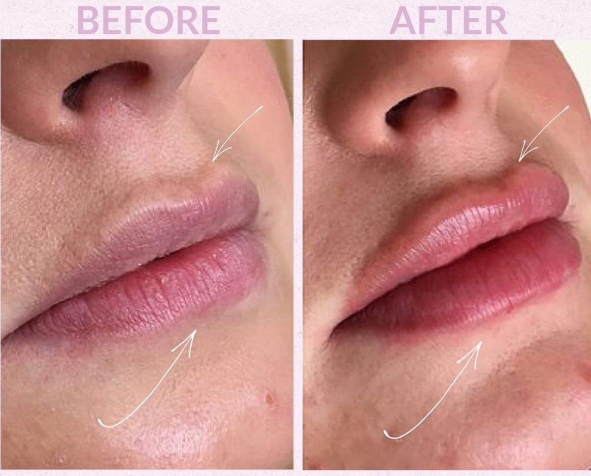 Lip Filler Special - $100 off!