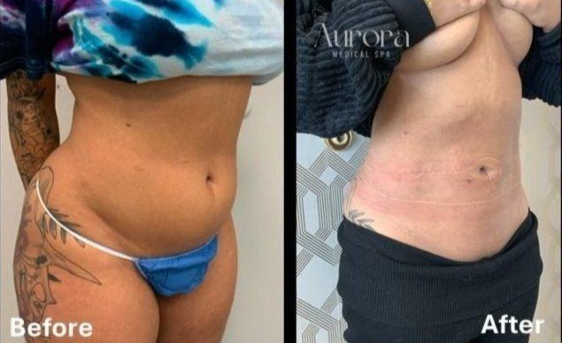 Smart Lipo- $750 OFF- Request a consult