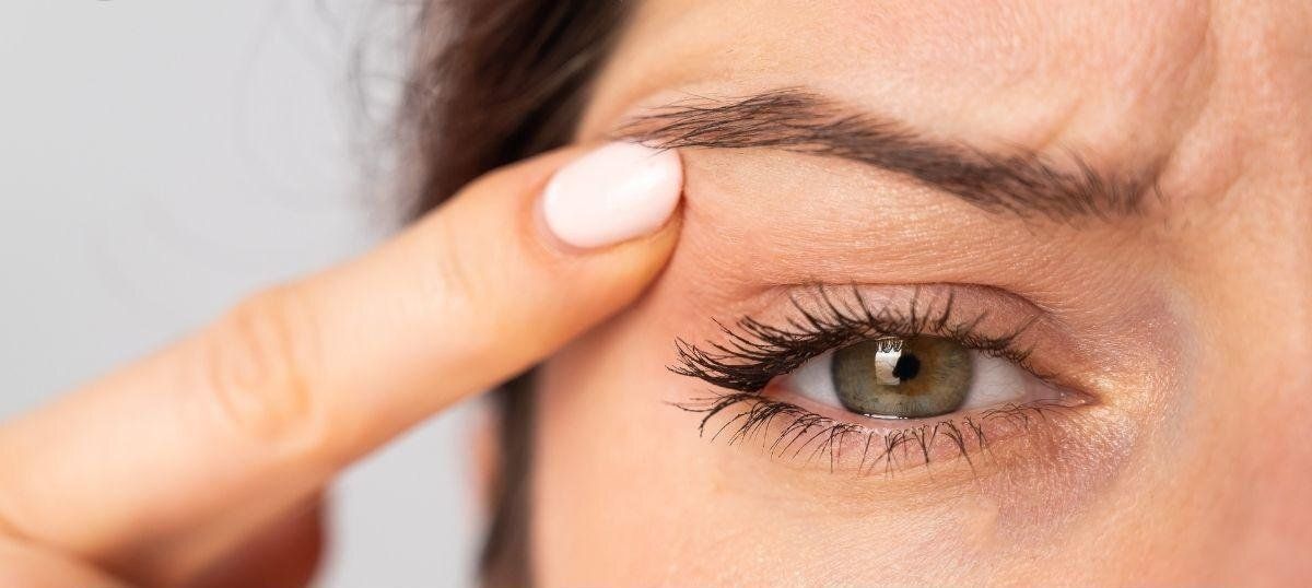  Ultherapy -Upper Face- Crows-Feet, Under-Eye & Brow Lift