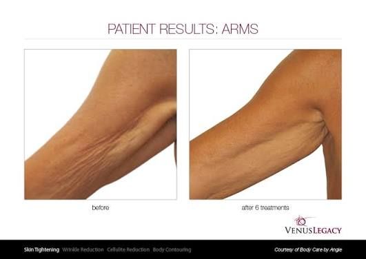 Venus Bless MAX- Body Countering & Tightening