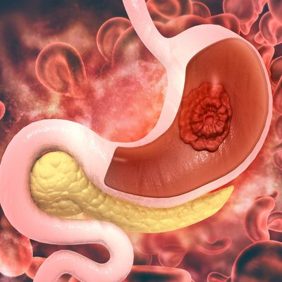 Verkörperung der Magen-Gesundheit - Ferry Puthut Handoko