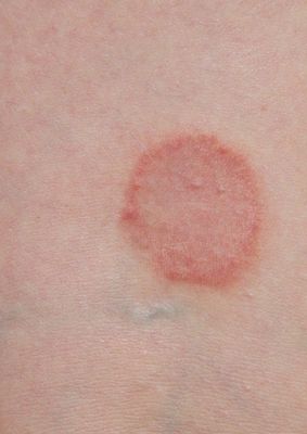 Ätherische Unterstützung bei Lichen sclerosus – Rainer Marock & Nicola Wellhausen