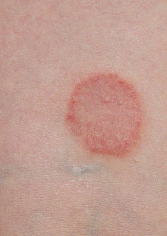 Ätherische Unterstützung bei Lichen sclerosus – Rainer Marock & Nicola Wellhausen