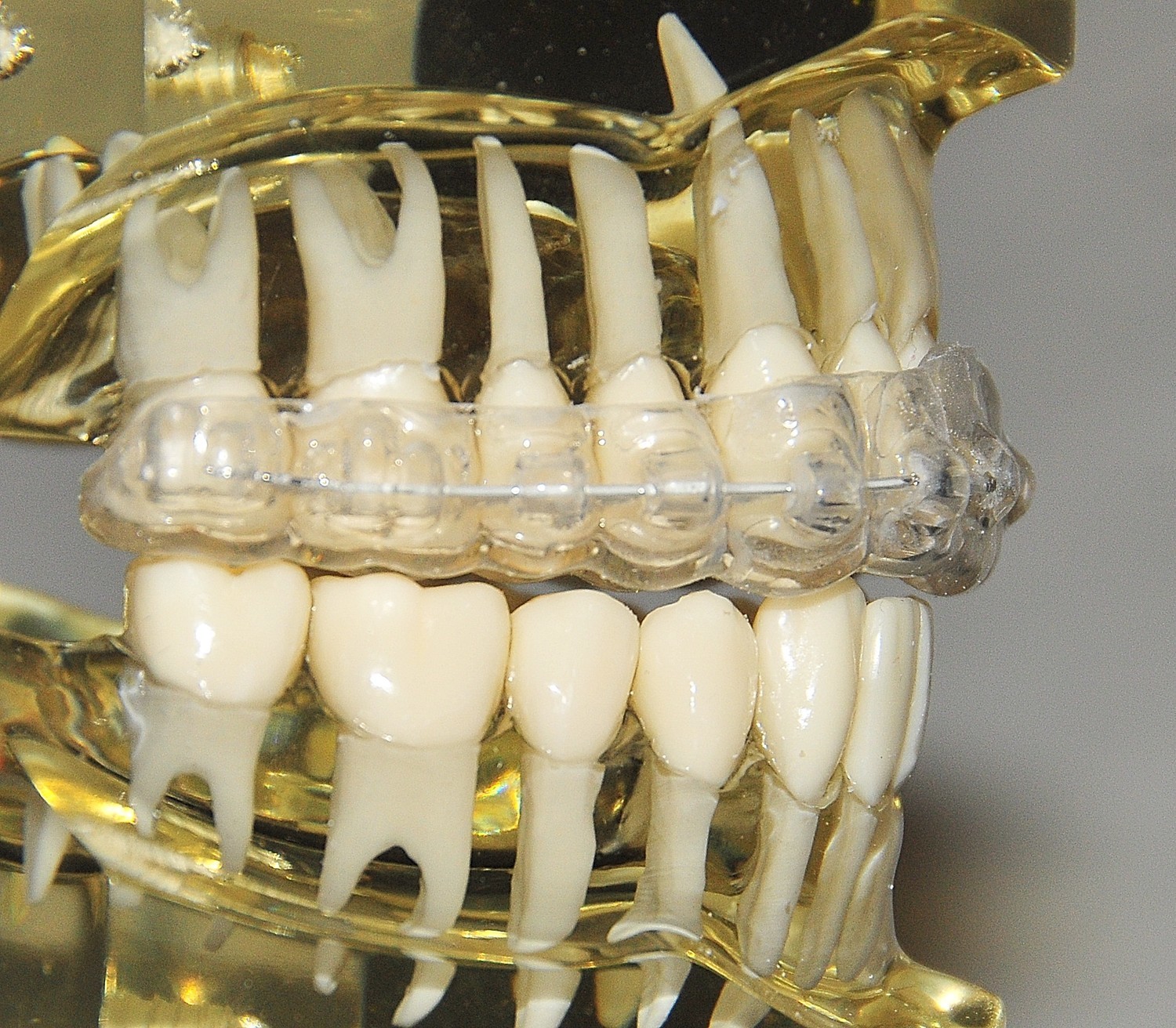 First Stage of Treatment: Hybrid Clear Aligner System