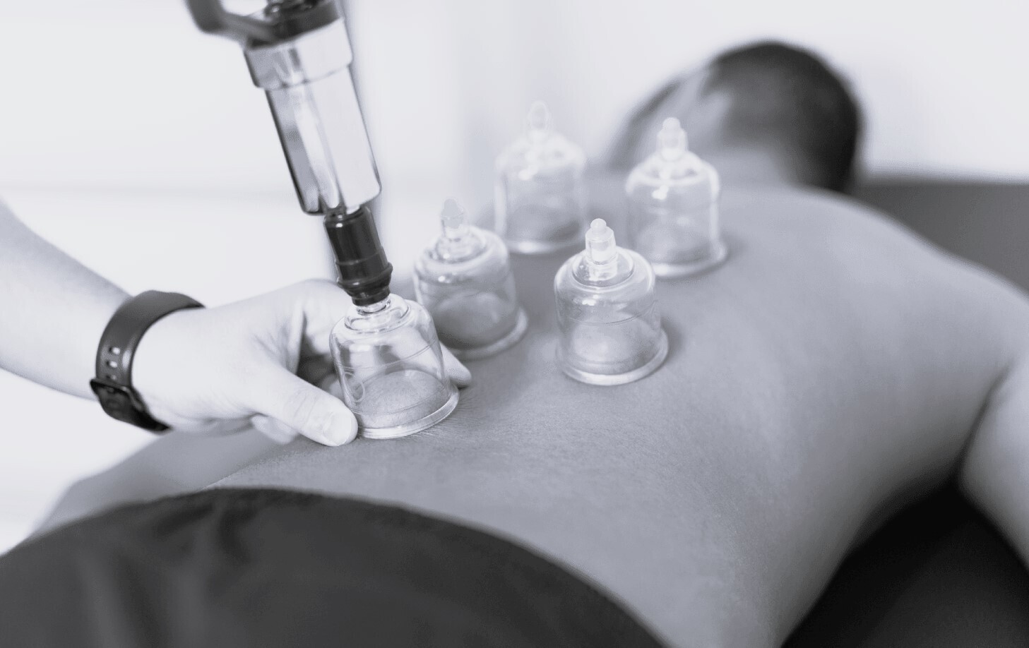 DRY CUPPING THERAPY