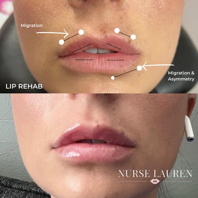 Filler Reversal Management