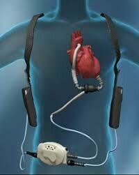 Ventricular Assist Devices