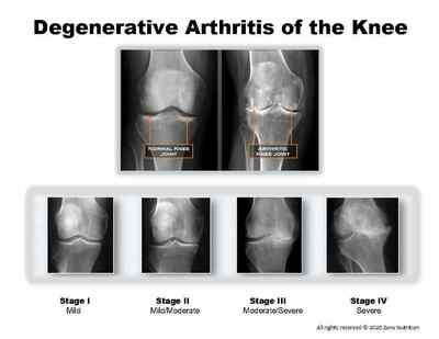 Degenerative Arthritis of the Knee