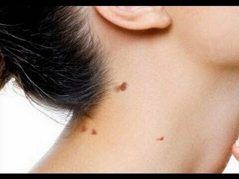 Ten Skin Tag, Cherry Spot, Milia, or White Bump Removal